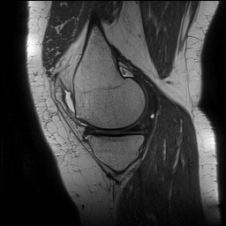 Acute-on-chronic transient lateral patellar dislocation with trochlear dysplasia (Radiopaedia 84099-99349 Sagittal PD 53).jpg