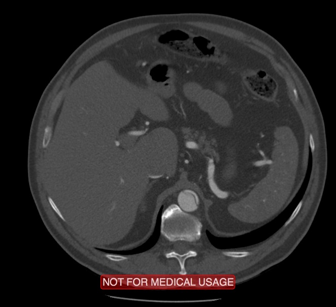 Acute aortic dissection - Stanford type A (Radiopaedia 40661-43285 Axial C+ arterial phase 81).jpg