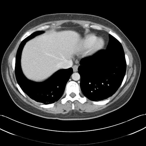 File:Acute appendicitis (Radiopaedia 30297-30934 Axial C+ portal venous phase 8).jpg