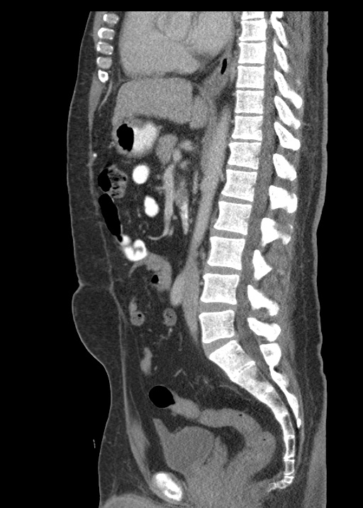 Acute appendicitis (Radiopaedia 48511-53463 Sagittal C+ portal venous phase 72).jpg