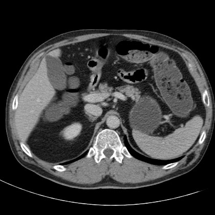 File:Acute appendicitis (Radiopaedia 66513-75790 Axial C+ portal venous phase 13).jpg