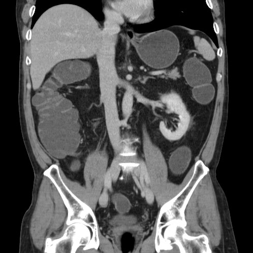 Acute appendicitis (Radiopaedia 66513-75790 Coronal C+ portal venous phase 43).jpg