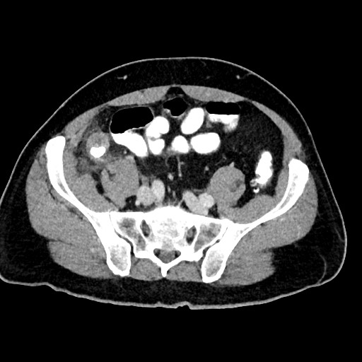 Acute appendicitis (Radiopaedia 77016-88960 Axial C+ portal venous phase 106).jpg
