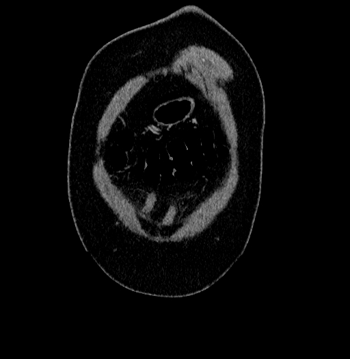 Acute appendicitis (Radiopaedia 79950-93224 Coronal C+ portal venous phase 1).jpg