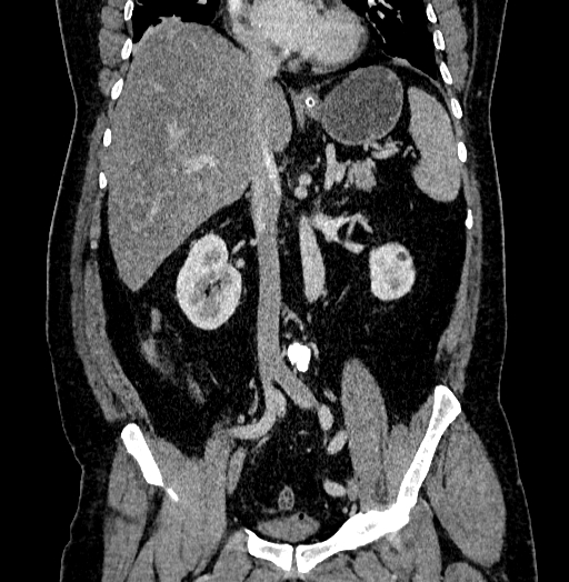 File:Acute appendicitis (Radiopaedia 79950-93224 Coronal C+ portal venous phase 49).jpg
