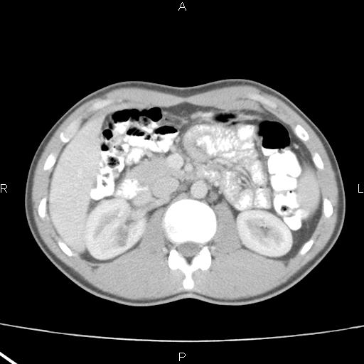 File:Acute appendicitis with CT arrowhead sign (Radiopaedia 21474-21411 Axial C+ portal venous phase 14).jpg