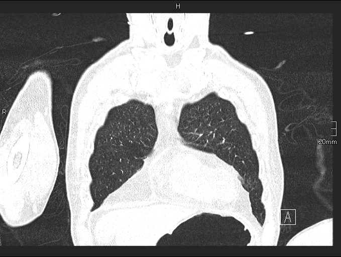 Acute aspiration pneumonitis (Radiopaedia 55642-62166 Coronal lung window 17).jpg