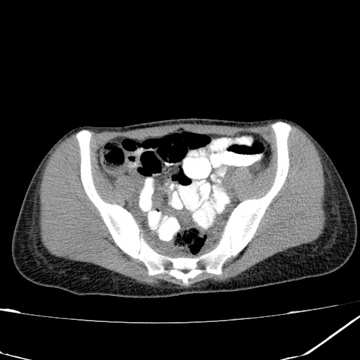 Acute bilateral pyelonephritis (Radiopaedia 74153-84969 Axial non-contrast 40).jpg