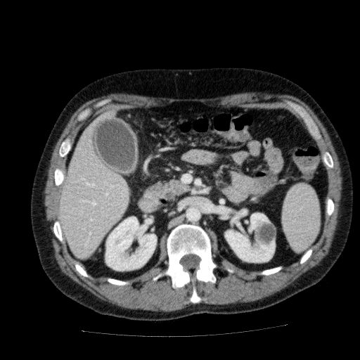 File:Acute cholecystitis and incidental left sided IVC (Radiopaedia 49352-54459 Axial C+ portal venous phase 61).jpg