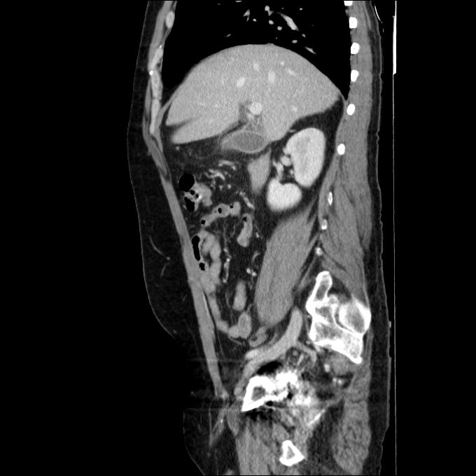 Acute cholecystitis and incidental left sided IVC (Radiopaedia 49352-54459 Sagittal C+ portal venous phase 59).jpg