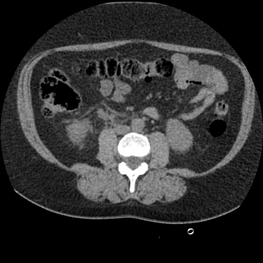 File:Acute cholecystitis and ureteric colic (Radiopaedia 42330-45444 Axial prone 55).jpg