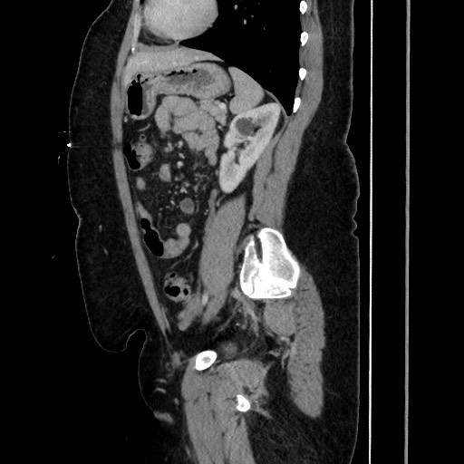 Acute diverticulitis - transverse colon (Radiopaedia 87063-103327 Sagittal C+ portal venous phase 149).jpg