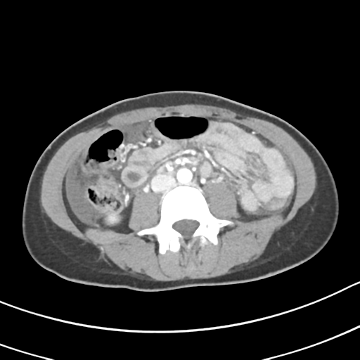 Acute gangrenous appendicitis with perforation (Radiopaedia 40152-42662 Axial C+ portal venous phase 37).png