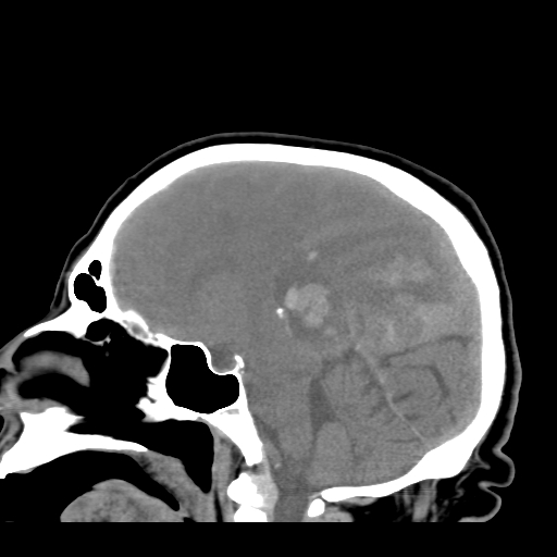 File:Acute hemorrhagic stroke (Radiopaedia 17507-17223 Sagittal non-contrast 23).jpg