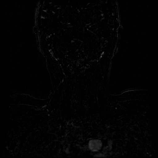 Acute internal carotid artery dissection (Radiopaedia 53541-59632 Coronal MRA 1).jpg