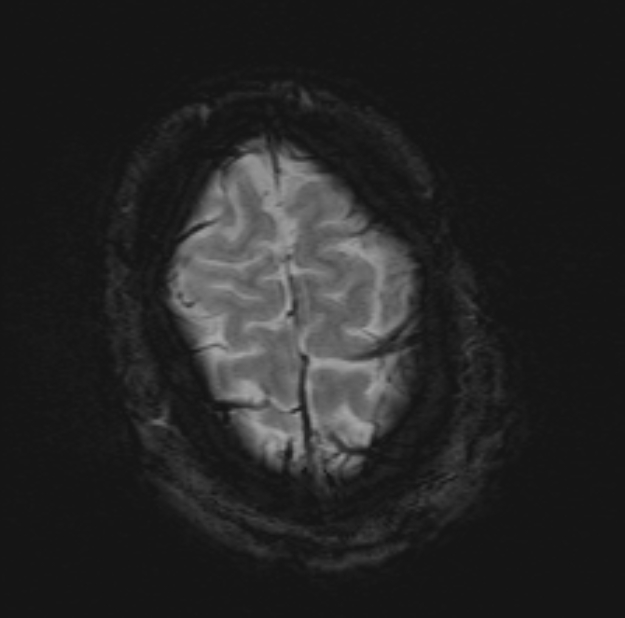 Acute ischemic stroke - posterior circulation territory (Radiopaedia 77670-89880 Axial SWI 52).jpg