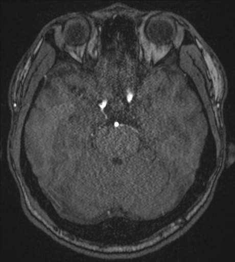 Acute left middle cerebral artery territory infarct with clot retrieval (Radiopaedia 47732-52433 Axial MRA 21).png