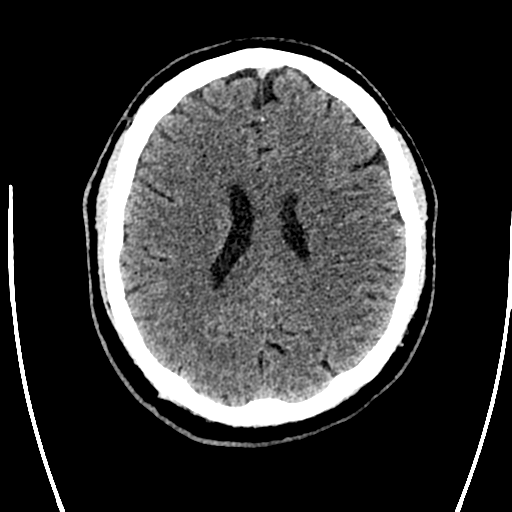 Acute left middle cerebral artery territory ischemic stroke (Radiopaedia 35688-37223 Axial non-contrast 52).png