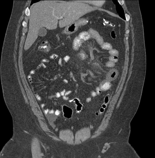 Acute mesenteric venous ischemia (Radiopaedia 46041-50383 Coronal C+ portal venous phase 31).jpg