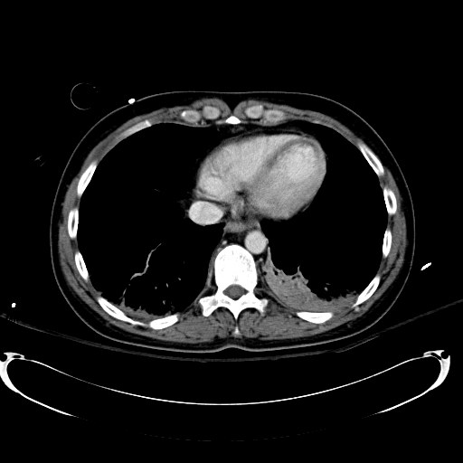 Acute myocardial infarction in CT (Radiopaedia 39947-42415 Axial C+ portal venous phase 11).jpg