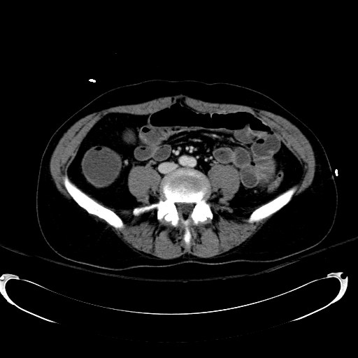 Acute myocardial infarction in CT (Radiopaedia 39947-42415 Axial C+ portal venous phase 81).jpg
