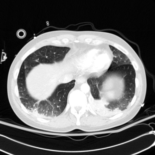 File:Acute myocardial infarction in CT (Radiopaedia 39947-42415 Axial lung window 108).jpg
