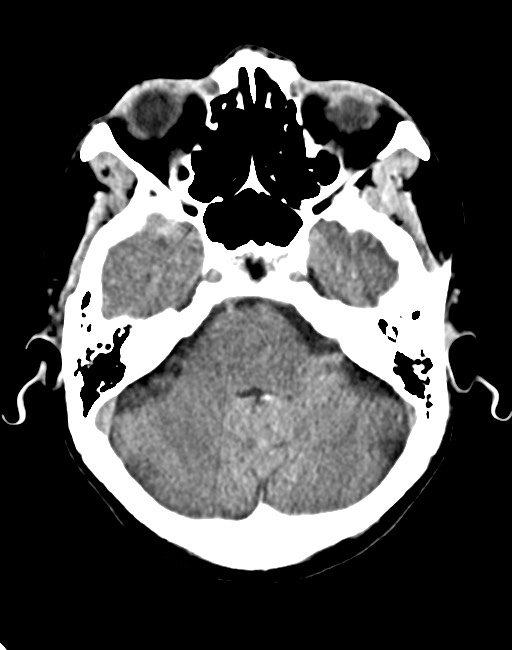 Acute on chronic subdural hematoma (Radiopaedia 74814-85823 Axial non-contrast 33).jpg