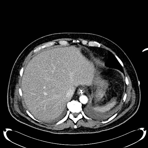 Acute pancreatic necrosis (Radiopaedia 13560-18500 Axial C+ portal venous phase 28).jpg