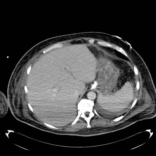 File:Acute pancreatic necrosis (Radiopaedia 13560-18503 Axial C+ portal venous phase 13).jpg