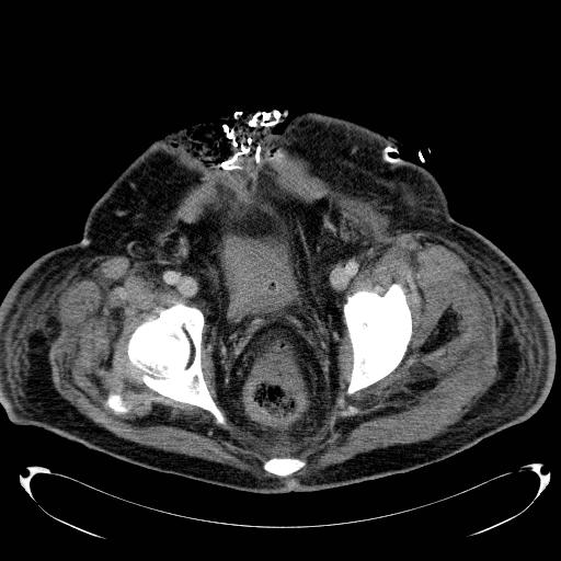 Acute pancreatic necrosis (Radiopaedia 13560-18503 Axial C+ portal venous phase 76).jpg