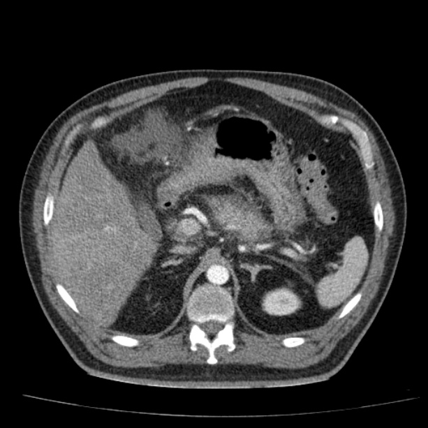 Acute pancreatitis (Radiopaedia 26663-26813 Axial C+ arterial phase 31).jpg