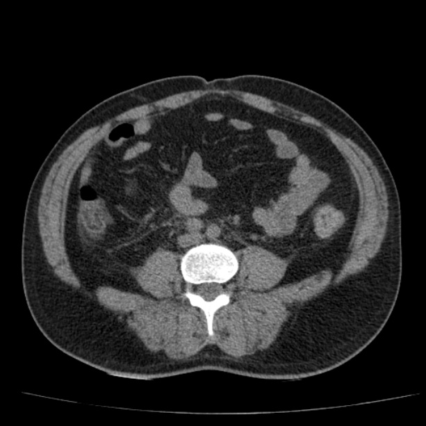 Acute pancreatitis (Radiopaedia 26663-26813 Axial non-contrast 63).jpg