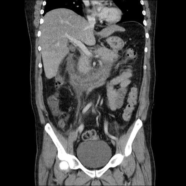 Acute pancreatitis (Radiopaedia 26663-26813 Coronal C+ portal venous phase 32).jpg