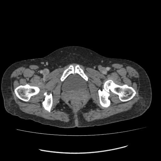 Acute pancreatitis (Radiopaedia 80007-93285 Axial C+ portal venous phase 123).jpg