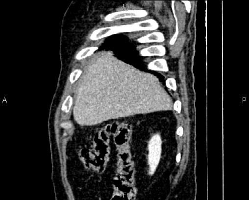 File:Acute pancreatitis (Radiopaedia 85146-100701 Sagittal C+ portal venous phase 12).jpg