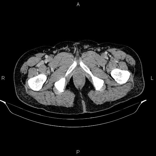 Acute pancreatitis (Radiopaedia 85390-101010 Axial C+ portal venous phase 116).jpg