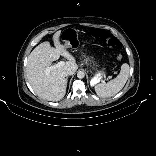 Acute pancreatitis (Radiopaedia 85390-101010 Axial C+ portal venous phase 25).jpg