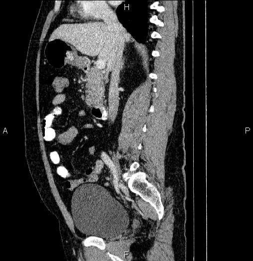 Acute pancreatitis (Radiopaedia 85390-101010 Sagittal C+ portal venous phase 42).jpg