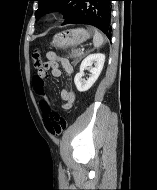 Acute pancreatitis - Balthazar E (Radiopaedia 23080-23110 Sagittal C+ portal venous phase 76).jpg