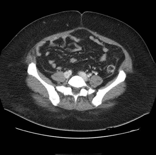 Acute pancreatitis - Balthazar E (Radiopaedia 29016-29377 Axial C+ portal venous phase 51).png