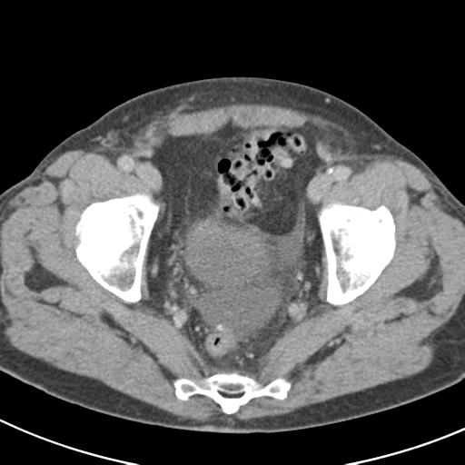 Acute pancreatitis and walled-off necrosis (Radiopaedia 29888-30403 Axial C+ delayed 75).jpg