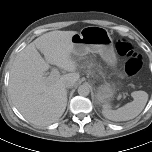 File:Acute pancreatitis and walled-off necrosis (Radiopaedia 29888-30403 Axial non-contrast 14).jpg
