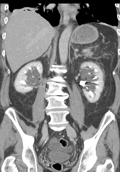 Acute pancreatitis and walled-off necrosis (Radiopaedia 29888-30403 E 36).jpg