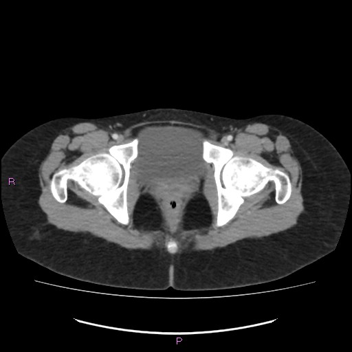 Acute pancreatitis secondary to stone at minor papilla and pancreatic divisum (Radiopaedia 76570-88333 Axial C+ portal venous phase 79).jpg