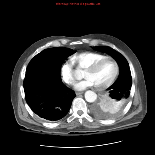 Acute pancreatitis with incidental pancreatic lipoma (Radiopaedia 10190-10730 Axial C+ arterial phase 7).jpg