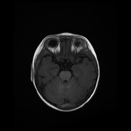 File:Acute phase of hemiconvulsion-hemiplegia epilepsy syndrome (Radiopaedia 29309-29745 Axial T1 16).jpg