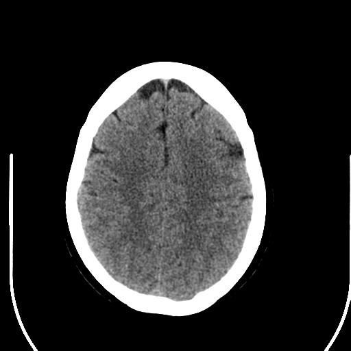 File:Acute pontine infarct from vertebral artery dissection (Radiopaedia 34111-35369 Axial non-contrast 22).png