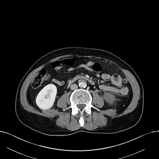 Acute renal infarction (Radiopaedia 59375-66736 Axial C+ portal venous phase 56).jpg