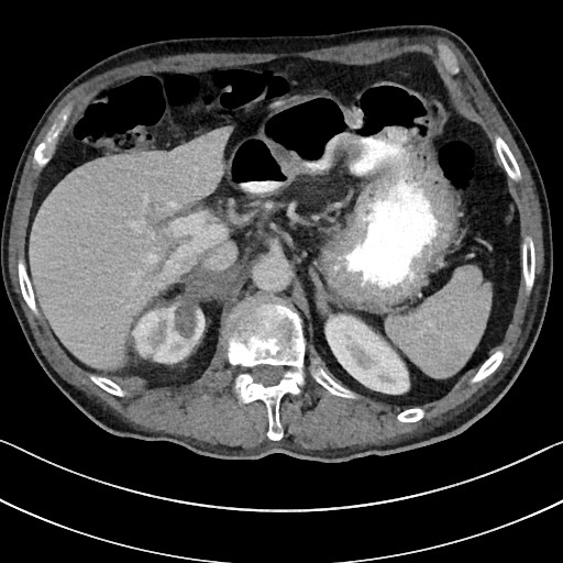 Acute renal infarction - rim capsular enhancement (Radiopaedia 59833-67270 Axial C+ portal venous phase 26).jpg