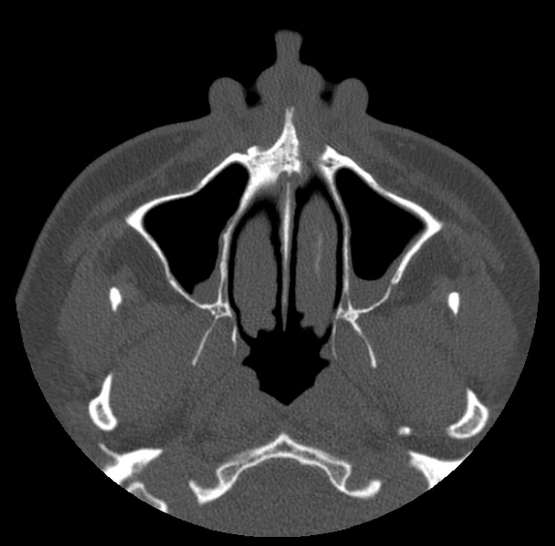 Acute sinusitis (Radiopaedia 23161-23215 Axial bone window 15).jpg